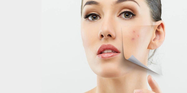 6 K-Beauty and Skincare Products To Cure Acne