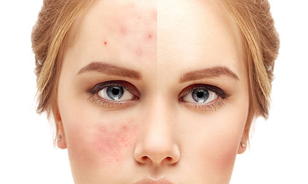 4 Best K-Beauty Tips From Dermatologist For Acne-Prone Skin