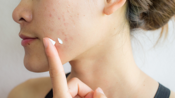 7 Tips To Prevent And Manage Acne + Recommended K-Beauty Products