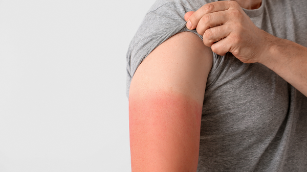 7 Sunburn Remedies and Treatments