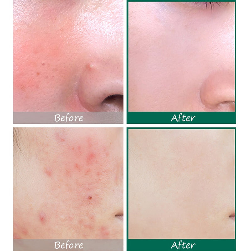 AHA, BHA, PHA 30 Days Miracle Serum (50ml)